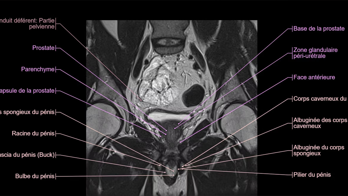 IRM de l'abdomen et du pelvis